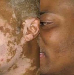 Encuentran cubanos cura contra el vitiligo